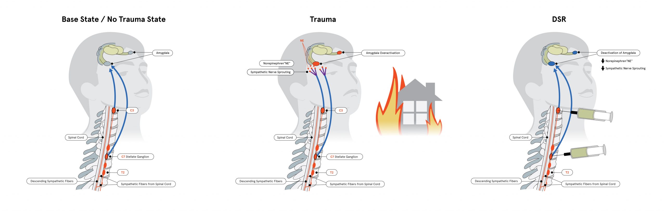 The image consists of three diagrams illustrating different states of the human nervous system in response to trauma. Each diagram shows a side view of a human head and upper spine with detailed labels.

The first diagram, titled "Base State / No Trauma State," depicts a normal state without trauma. It shows the brain, spinal cord, and various nerves with labels indicating their functions:

Brain
Sympathetic preganglionic neuron
Sympathetic ganglion
Sympathetic postganglionic neuron
Parasympathetic preganglionic neuron
Parasympathetic ganglion
Parasympathetic postganglionic neuron
The second diagram, titled "Trauma," illustrates the nervous system's response to trauma. It includes an image of a house on fire in the background to symbolize trauma. Additional elements are highlighted:

Increased activity in sympathetic neurons (indicated by red arrows)
Decreased activity in parasympathetic neurons (indicated by blue arrows)
The third diagram, titled "DSR," represents the state after trauma has been addressed using Dorsal Root Stimulation (DSR). This includes:

A device implanted near the spine with wires connected to it.
Labels indicating restored balance between sympathetic and parasympathetic activities.
Each diagram includes detailed anatomical structures such as vertebrae and nerves with corresponding labels for clarity.